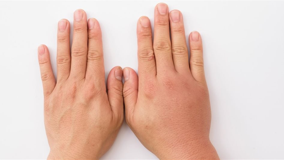 Experts explain why swelling in arms and legs rises in summer