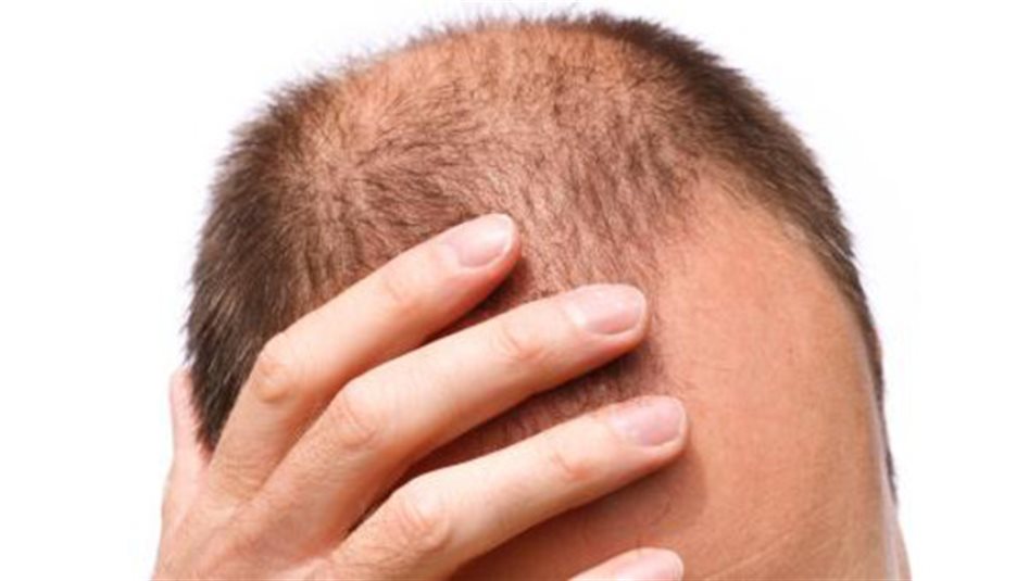ما علاقة الصلع المبكر بالاصابة بسرطان البروستات.. دراسة تجيب