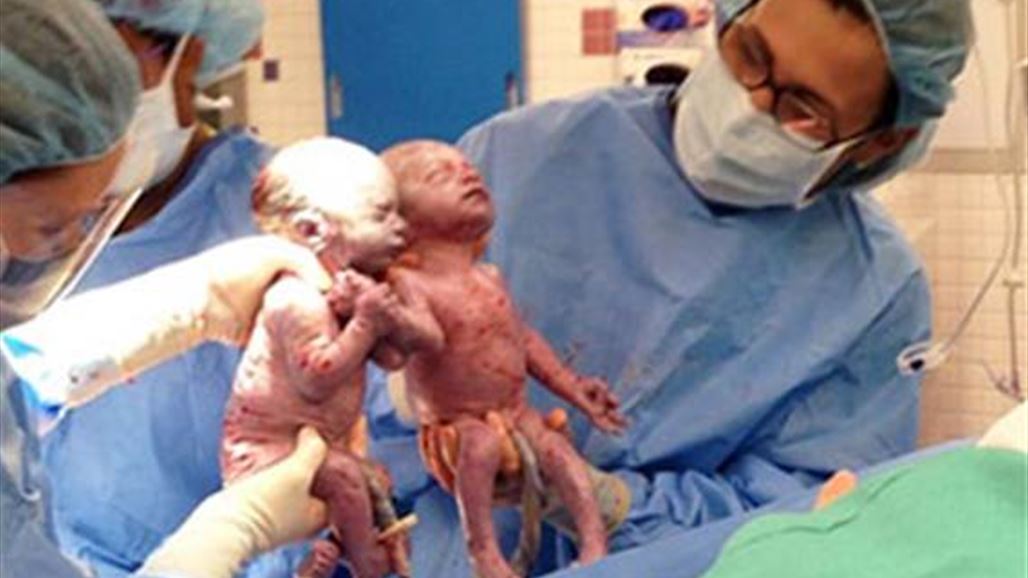 حدث مدهش...طفلتان توأمان تخرجان الى الحياة بأيادِ متشابكة!