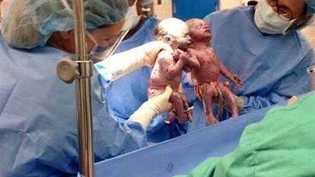 طفلة تمسك بيد اخيها التوأم منذ لحظة ولادتها الاولى