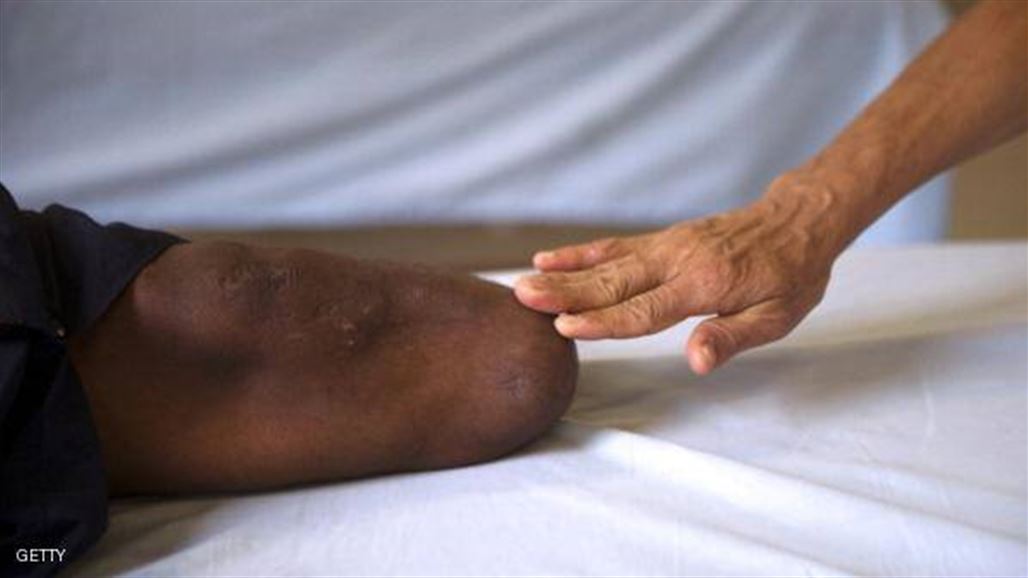 اميركي يقاضي مستشفى بعد العثور على ساقه بالقمامة