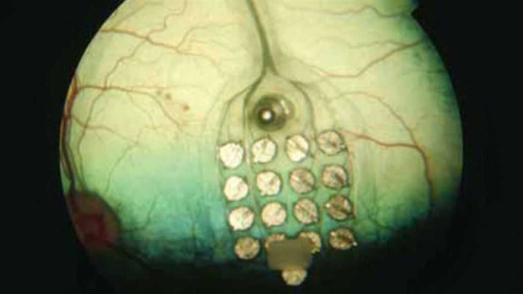 أطباء يكتشفون سبب إصابة مرضى السكري بالعمى ويكافحونه