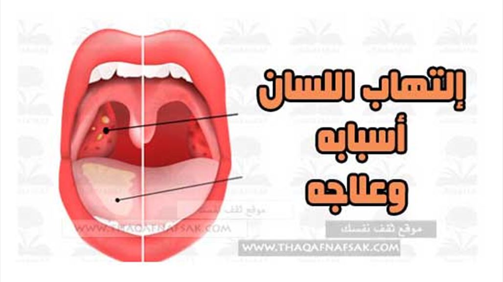 5 طرق فعالة لعلاج إلتهاب اللسان