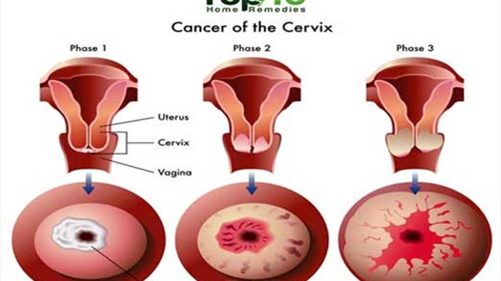 عشر علامات تشير الى إصابتكِ بسرطان عنق الرحم