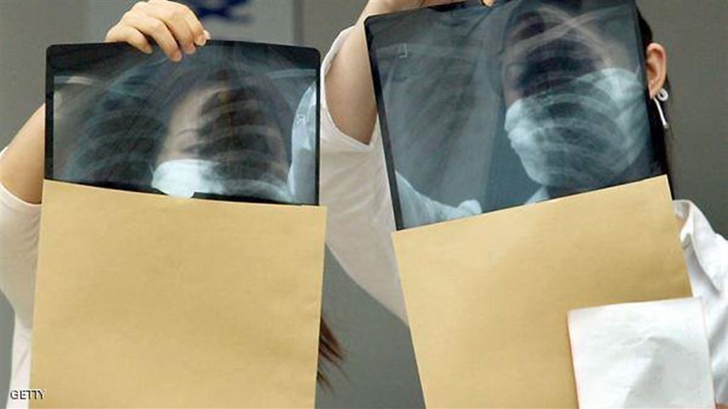 إسبانيا تجري أول عملية لزرع قفص صدري "مطبوع"