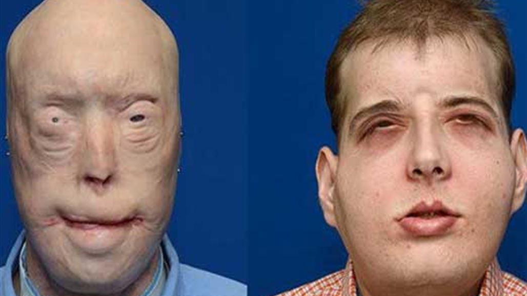 في أكبر عملية تاريخية متبرع يهب وجهه لرجل إطفاء