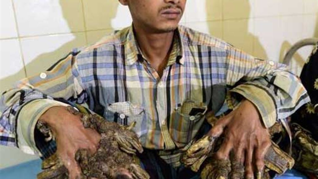 بالفيديو: من هو "رجل الشجرة" ؟