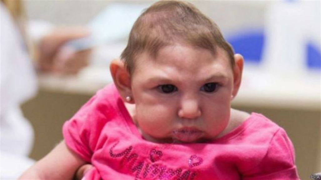 ولادة أول طفل برأس صغير متأثرا بزيكا في اسبانيا
