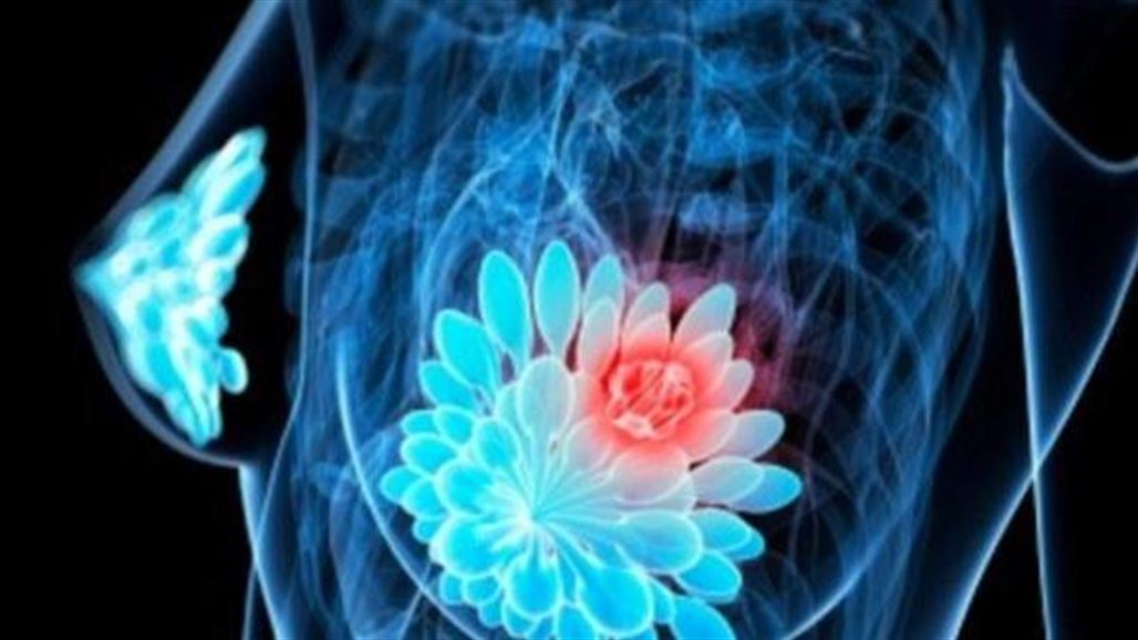 أطباء: النظام الغذائي الجيد يمنع سرطان الثدي