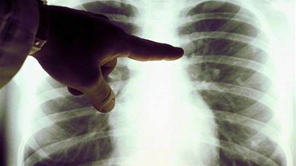 هل ستُطوّر مايكروسوفت علاجاً للسرطان؟