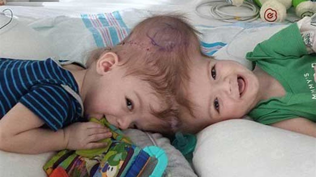 فصل توأمين ملتصقي الرأس في عملية استغرقت 20 ساعة