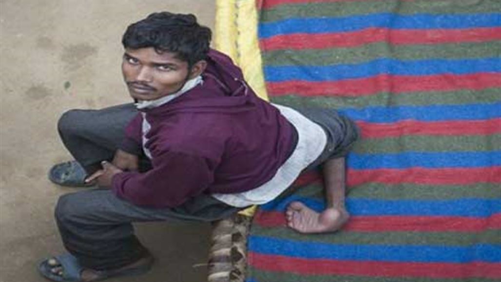 بالصور: رجل بأربعة أرجل