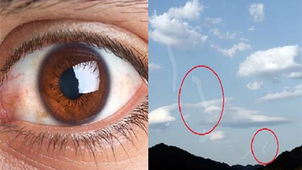 أترى بقعاً صغيرة تتحرك أمام عينيك؟ إكتشف السّبب...