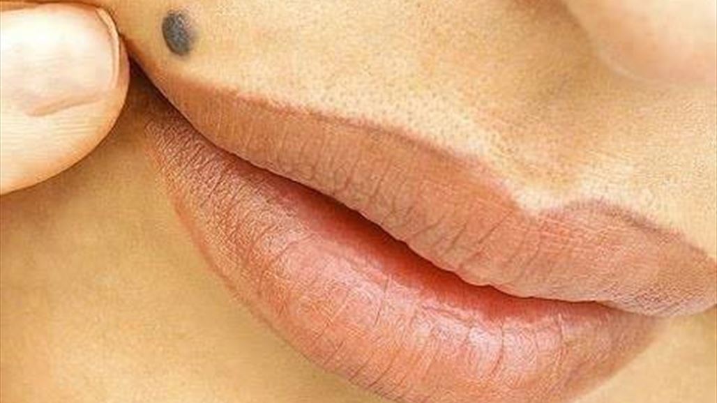 كيف نفرّق الشامة الحميدة من الخبيثة في الجسم؟