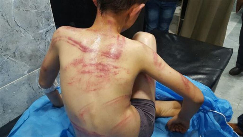 إدخال طفل إلى مستشفى كركوك بعد تعرضه لضرب بصورة "وحشية" من قبل والده