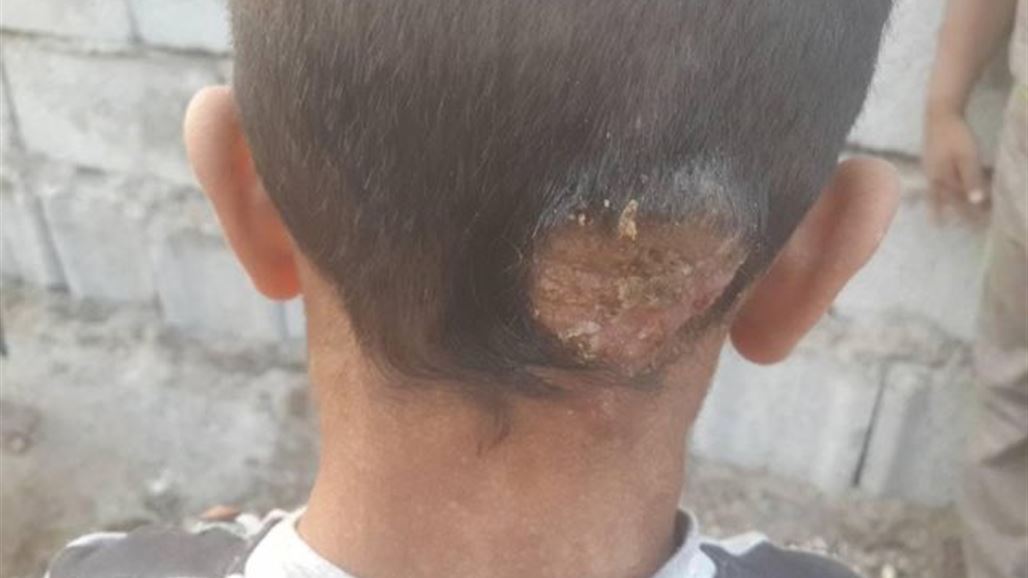 "الجرب" يهدد حياة اطفال بعمر الزهور في ديالى