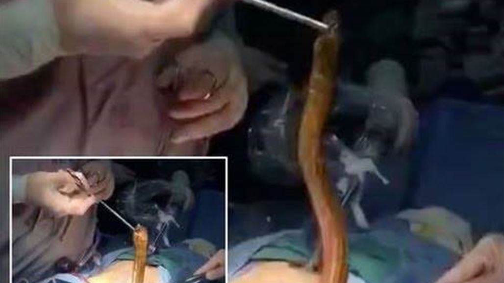 استخراج ثعبان حيّ من معدة رجل صينيّ