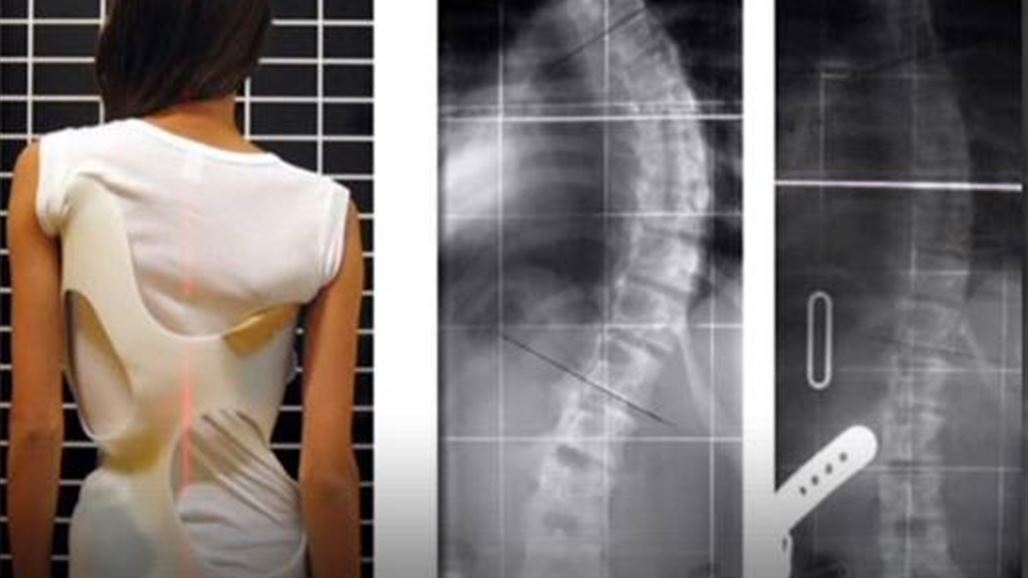 تقنية متطورة لعلاج تشوه العمود الفقري من دون عملية جراحية