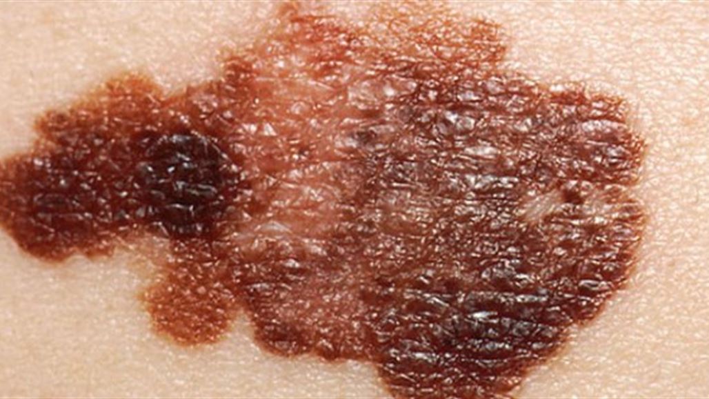 بالصور .. طفلة تذهل الناظرين بحملها شامة تحير الأطباء