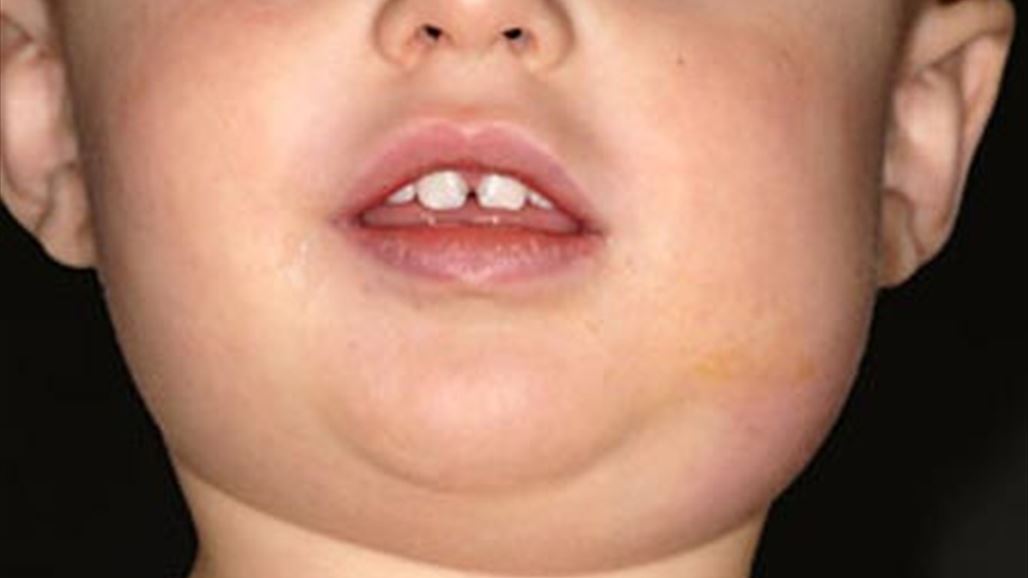 مسؤول محلي يعلن احتواء مرض "النكاف" في ثاني اكبر نواحي ديالى