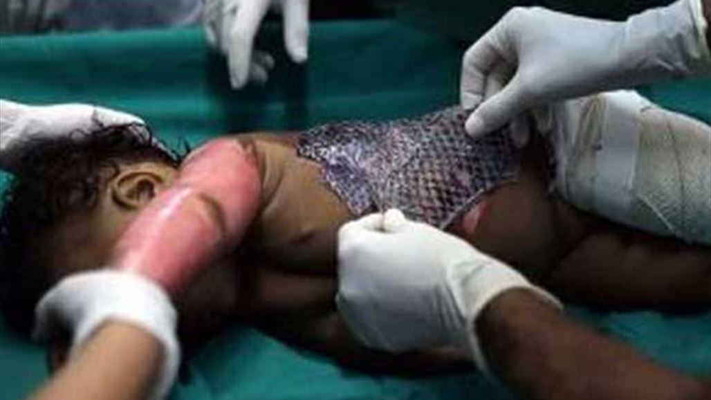 هل صحيح ان جلد السمك علاج "سحري" للحروق؟