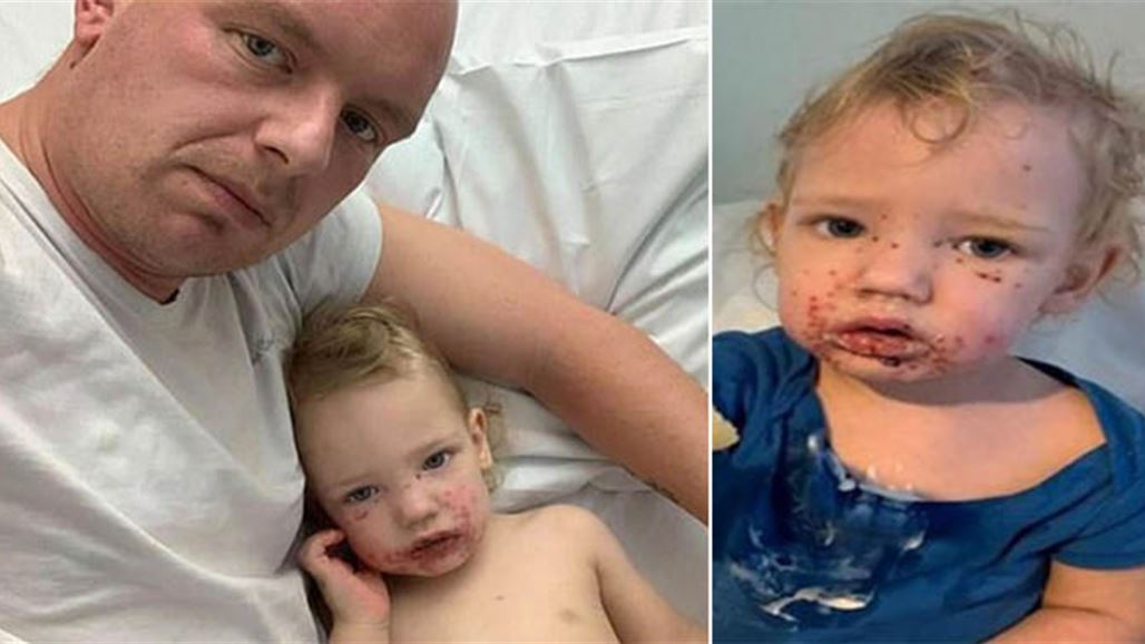 بالصور: قبلة بريئة تتحول لمرض قاتل