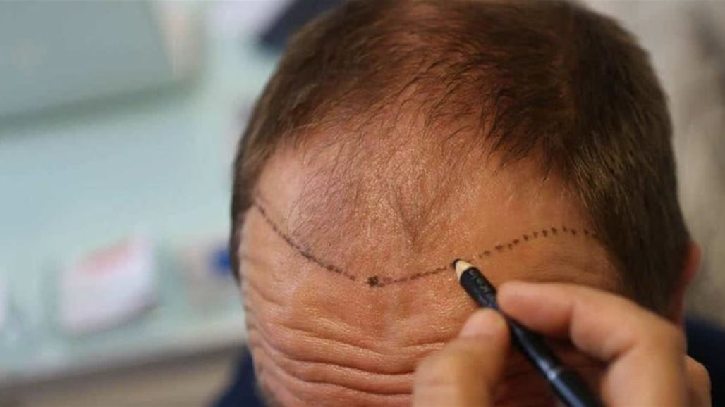بسبب زراعة الشعر... وفاة شخص تحير الأطباء