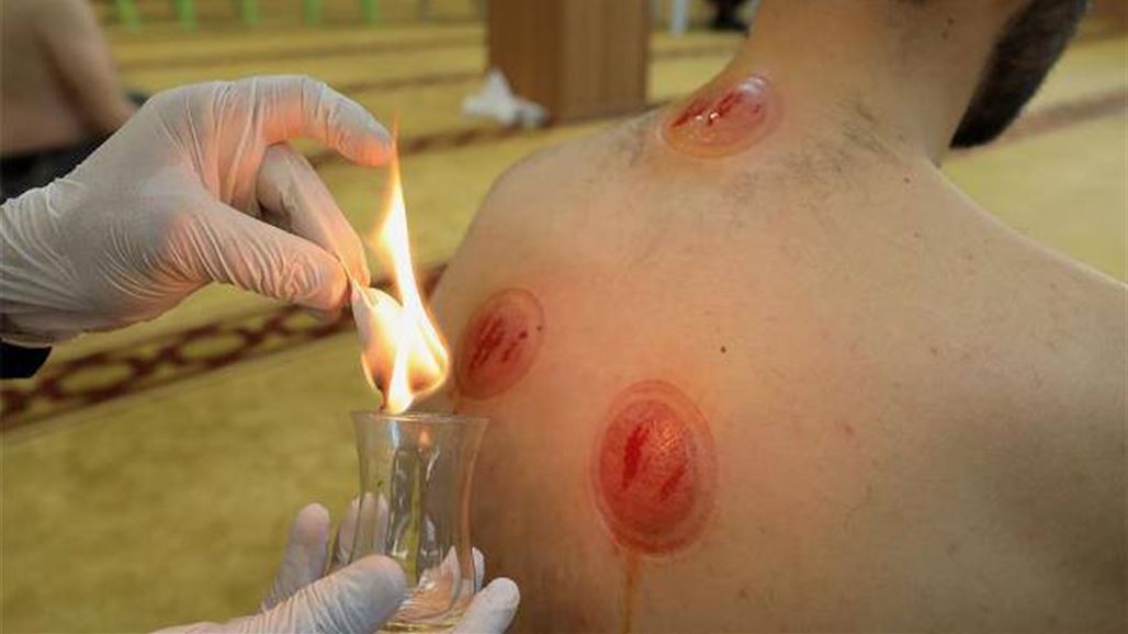 منذ 16 عاماً.. عراقي يعالج ربع مليون شخص بـ"الحجامة"