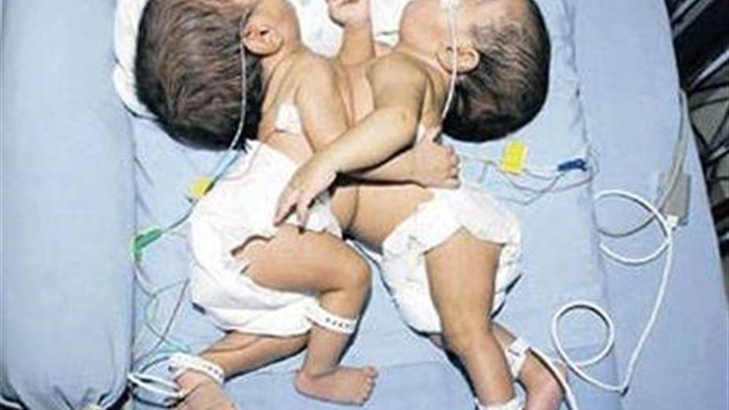 العاهل السعودي يتكفل بعلاج توأم سيامي ولد في محافظة الانبار